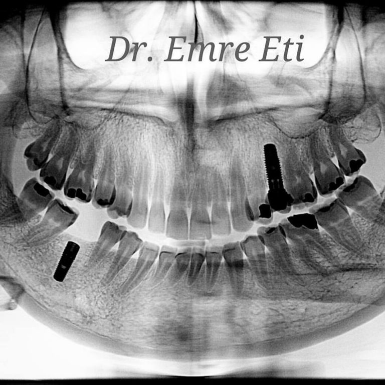 FOTO GALERİ Uzm. Dr. Emre Eti Endodontist ( Kanal Tedavisi Uzmanı