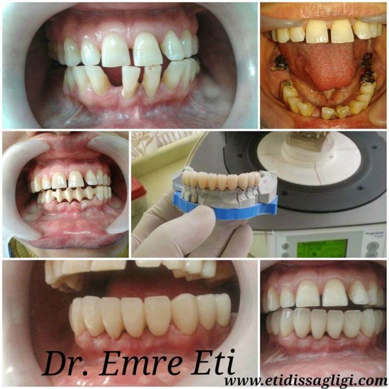 FOTO GALERİ Uzm. Dr. Emre Eti Endodontist ( Kanal Tedavisi Uzmanı